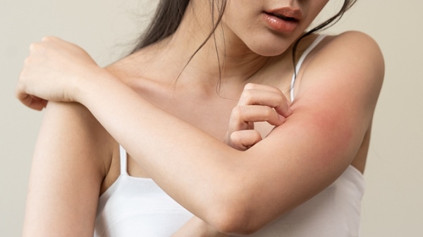 아토피성 피부염이 정신 건강에 미치는 영향에 대한 조사가 진행됐다 [사진: 셔터스톡]