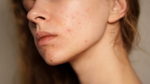 최근 틱톡 등에서 뜨거운 햇빛 아래 여드름 피부를 살균하는 '썬버닝'이 유행하고 있다. [사진: 셔터스톡]